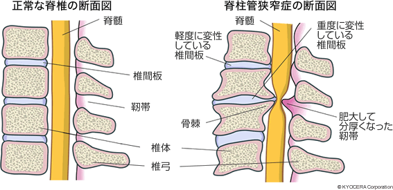 正常な脊椎の断面図 脊柱管狭窄症の断面図