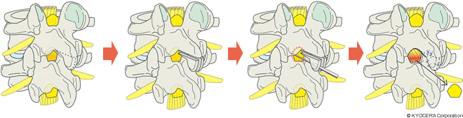 黄色靭帯を切除する除圧術