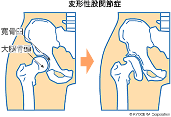 変形性股関節症