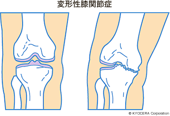 変形性膝関節症