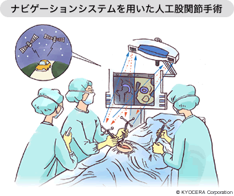 ナビゲーションシステムを用いた人工股関節手術
