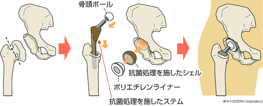 抗菌性人工股関節