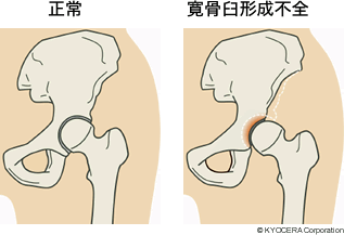 正常 寛骨臼形成不全