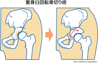 寛骨臼回転骨切り術