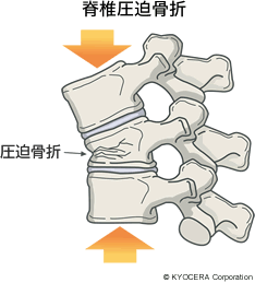 脊椎圧迫骨折