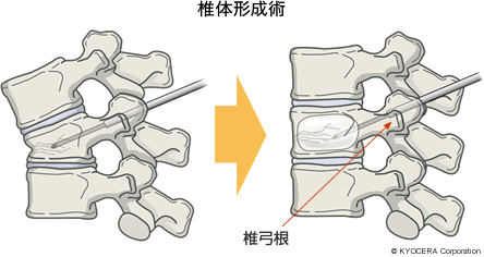 椎体形成術