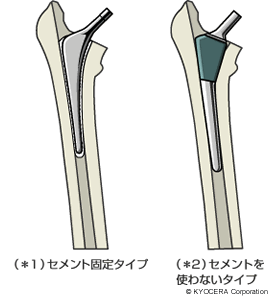 （＊１）セメント固定タイプ （＊2）セメントを使わないタイプ