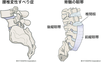  脊髄の靭帯 腰椎変性すべり症