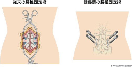 従来の腰椎固定術 低侵襲の腰椎固定術