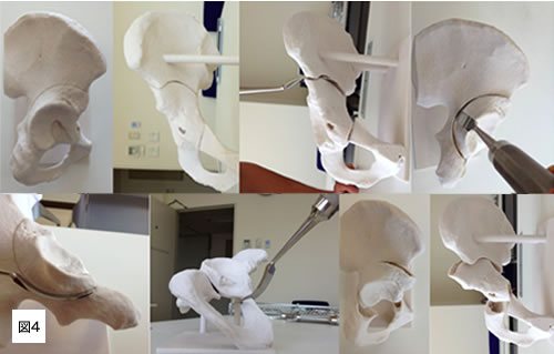 図4　寛骨臼回転骨切り術の実物大模型