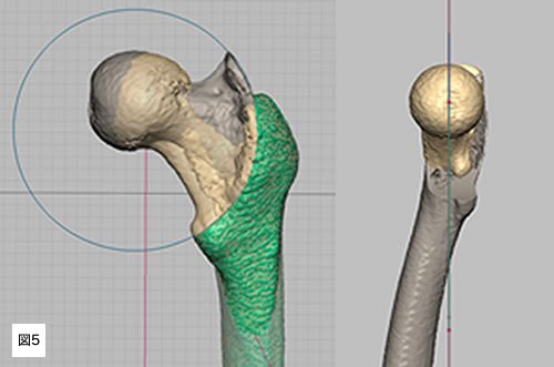 図5　大腿骨湾曲内反骨切り術の三次元画像による術前計画