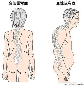 変性側弯症, 変性後弯症