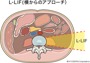 LIF手術（L-LIF）の侵入法