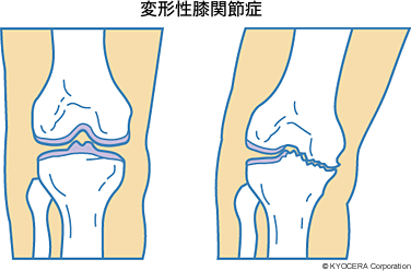 変形性膝関節症