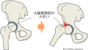 FAIの原因 大腿骨頸部が大きい