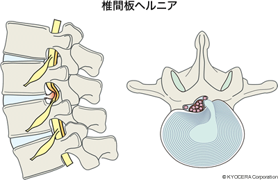 椎間板ヘルニア