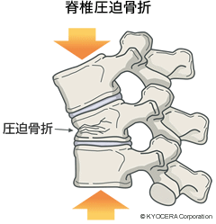 脊椎圧迫骨折