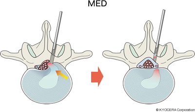 MED