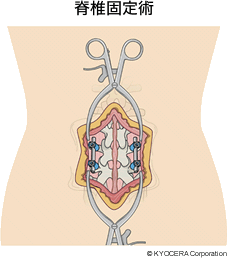脊椎固定術