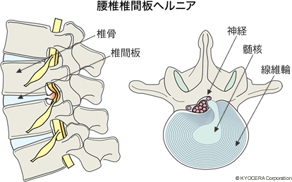 腰椎椎間板ヘルニア