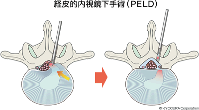 経皮的内視鏡下手術（PELD）