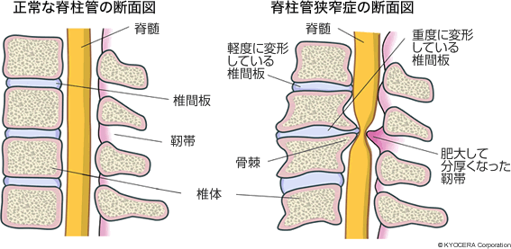 正常な脊柱管の断面図 脊柱管狭窄症の断面図
