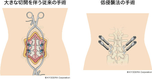 大きな切開を伴う従来の手術 低侵襲法の手術