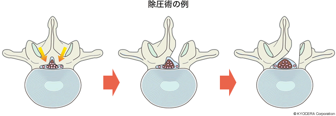 除圧術の例