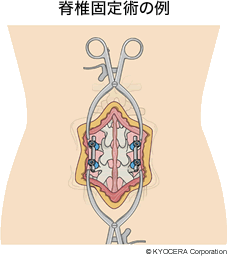 脊椎固定術の例