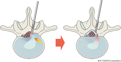 椎間板ヘルニアの手術