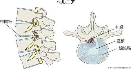 ヘルニア