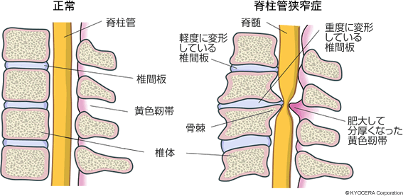 正常 脊柱管狭窄症