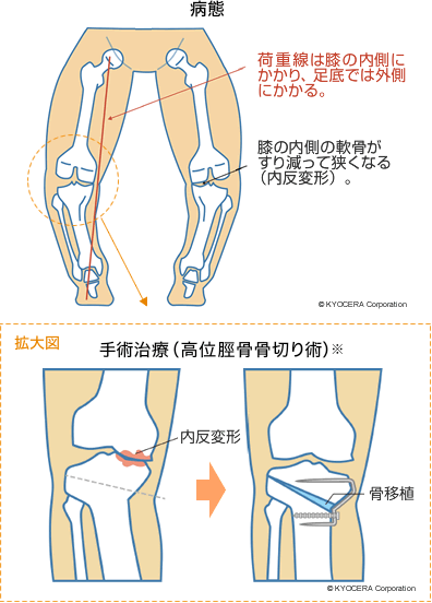 病態 手術治療（高位脛骨骨切り術）