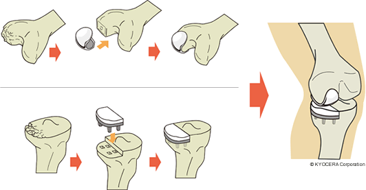 膝関節の片側だけを人工物に置換する方法