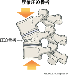 腰椎圧迫骨折