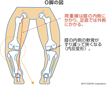 O脚の図 荷重線は膝の内側にかかり、足底では外側にかかる。 膝の内側の軟骨がすり減って狭くなる（内反変形）。