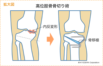 高位脛骨骨切り術