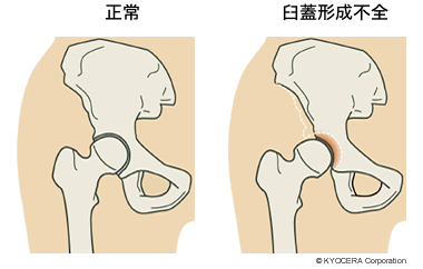 正常 臼蓋形成不全