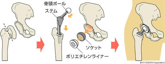 人工股関節