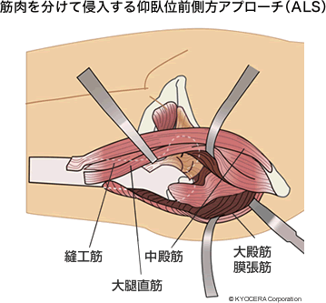 筋肉を分けて侵入する仰臥位前側方アプローチ(ALS)