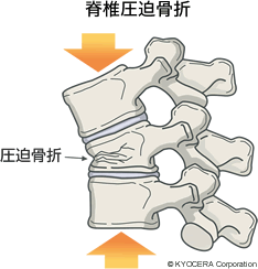 脊椎圧迫骨折