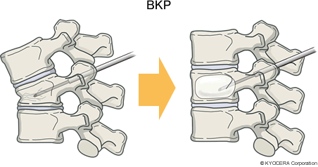 BKP