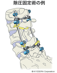 除圧固定術の例