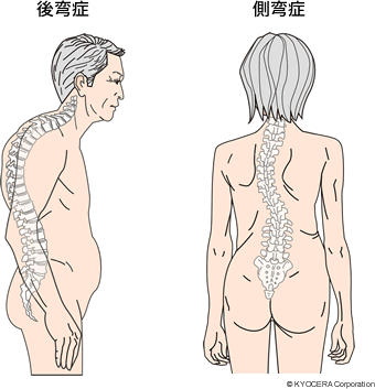 後弯症と側弯症