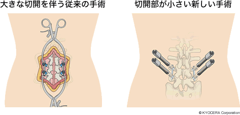 大きな切開を伴う従来の手術と切開部が小さい新しい手術