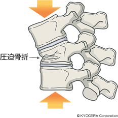 圧迫骨折