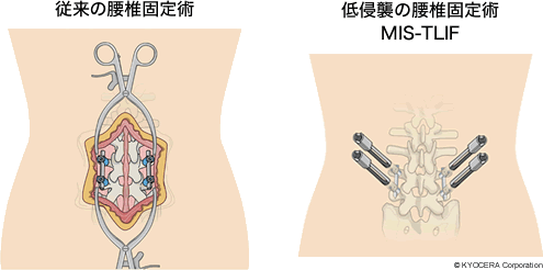 従来の腰椎固定術 低侵襲の腰椎固定術 MIS-TLIF