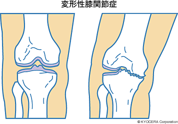 変形性膝関節症