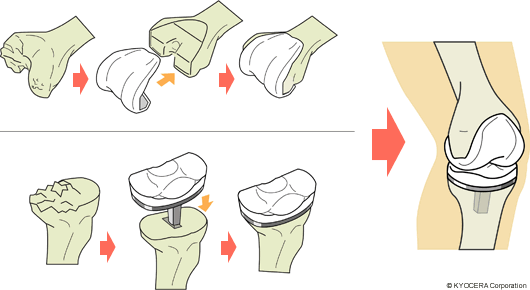 TKA（全人工膝関節置換術）