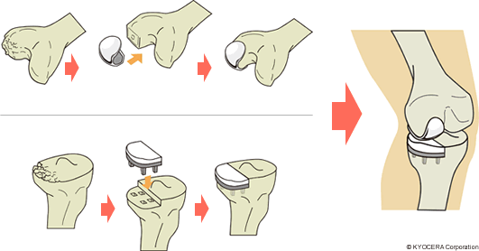 UKA（単顆人工膝関節置換術）